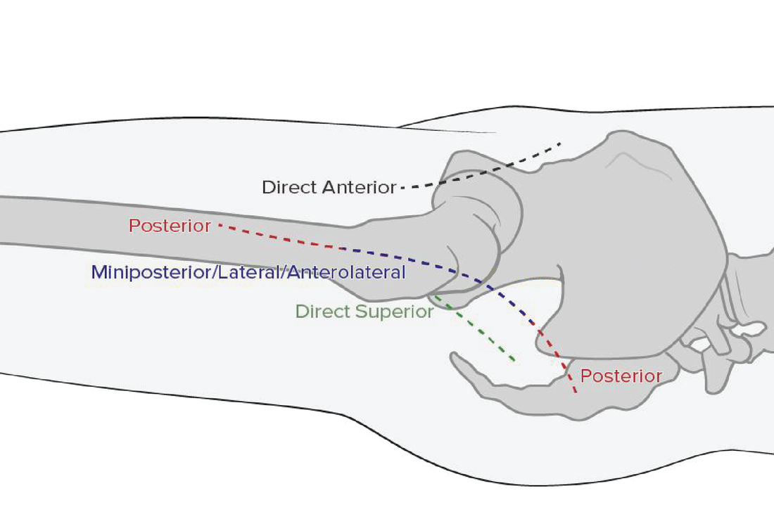 Direct Anterior Approach Hip Replacement Layton, Bountiful, Ogden, Salt  Lake City, Utah