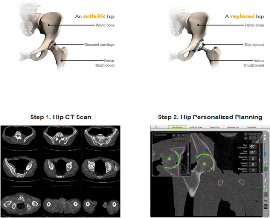 Robotic assisted hip surgery