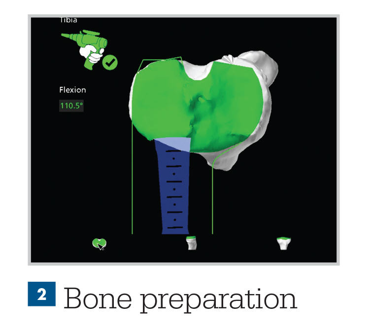 Robotic assisted hip surgery