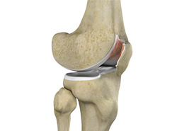 Chondromalacia Patella