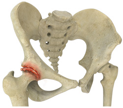 Osteoarthritis of the Hip